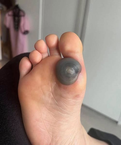 My daughter woke up with this huge spot on her foot
