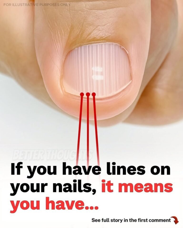 Vertical Lines on Your Nails: What Do They Really Mean for Your Health?