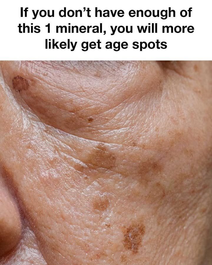 The Number One Deficiency Behind Aging Spots — And How to Naturally Address It Step by Step 