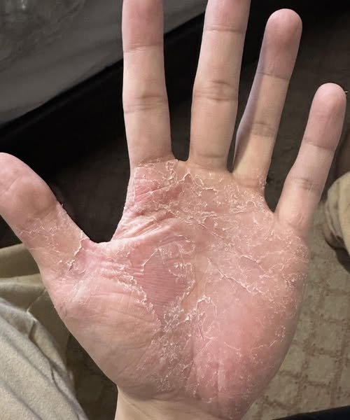 If This Appears on Your Hands, Be Careful. It Means You Have Ca…