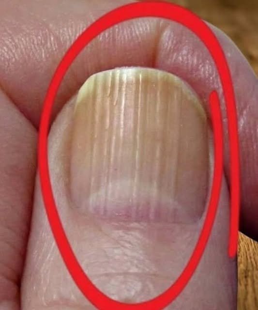 If you have lines on your nails, it means you have ca