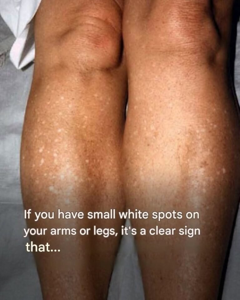 If you have small white spots on your arms or legs, it’s a clear sign that…See more
