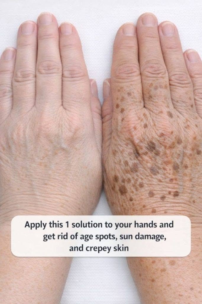 Apply this 1 solution to your hands and get rid of age spots, sun damage, and crepey skin.