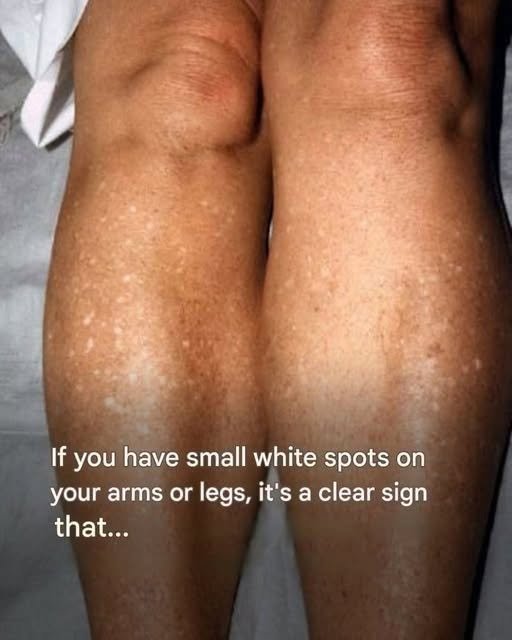 Why do I get white spots on my skin in the summer and how can I treat them? A dermatologist answers
