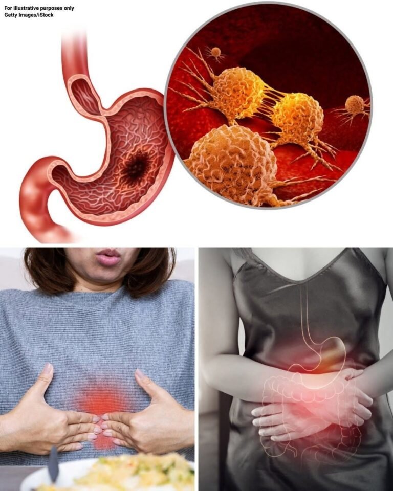 Stomach Can-cer: The “Silent Disease” You Shouldn’t Ignore