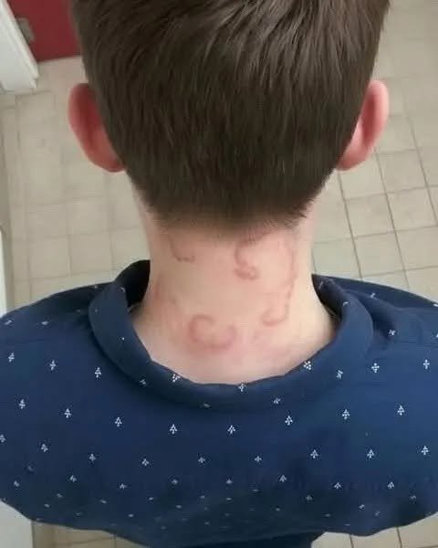What Could Cause These Marks on a Child’s Neck? Here’s What Parents Should Know
